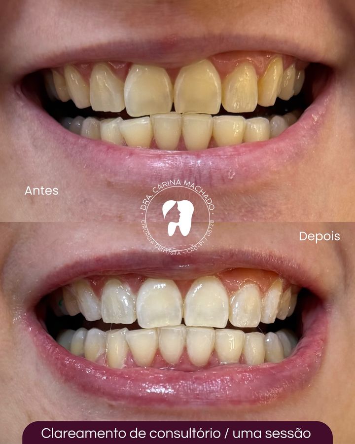 Antes e depois: Clareamento em uma sessão