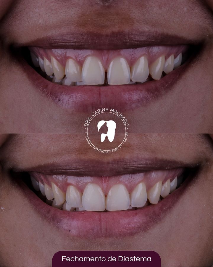 Antes e depois: Fechamento de diastema