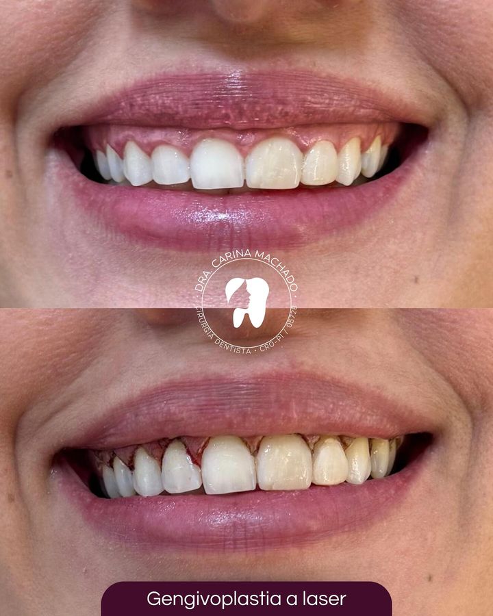 Antes e depois: Gengivoplastia a laser