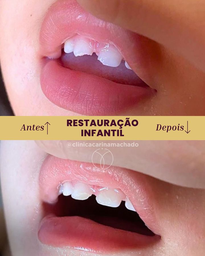 Antes e depois: Restauração infantil