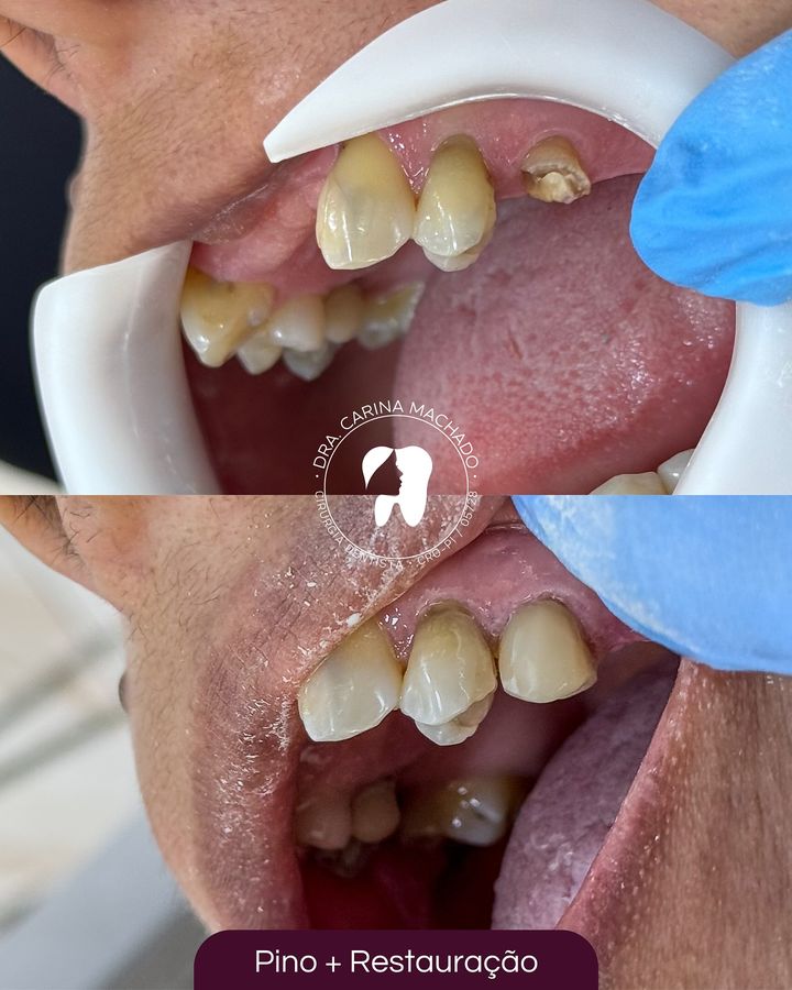 Antes e depois: Pino e restauração