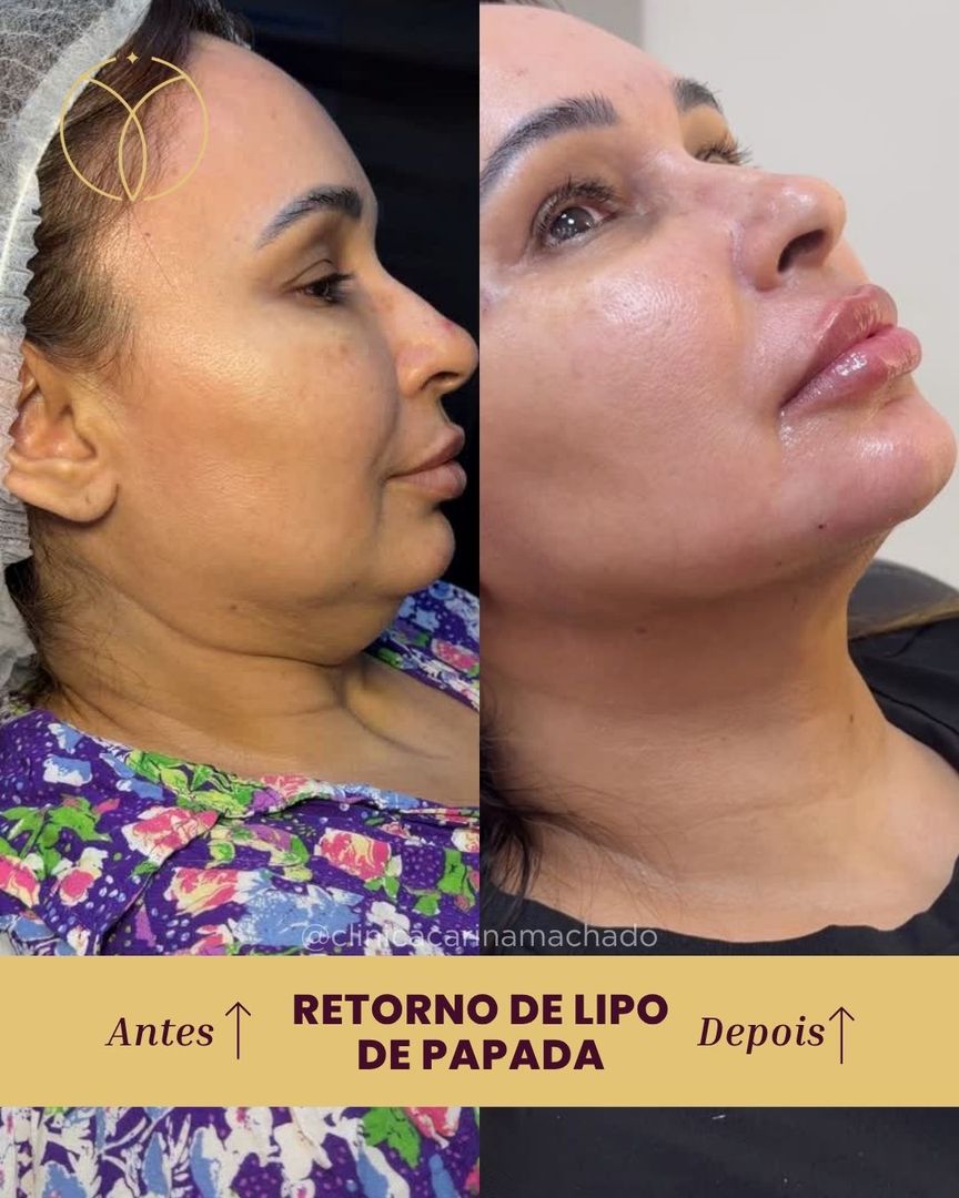Retorno de lipo de papada