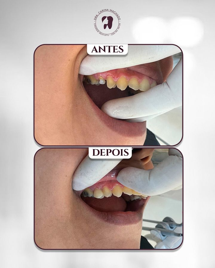 Antes e depois: Pino e coroa
